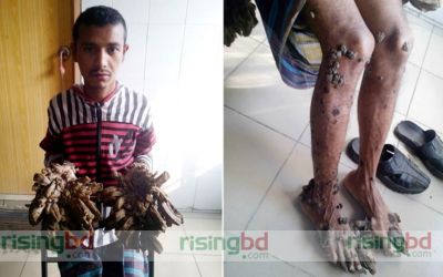 যেভাবে ট্রি-ম্যানের রোগের সূচনা