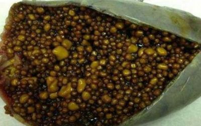 পিত্তথলিতে ১২ হাজার পাথর!