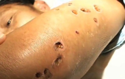 ভিমরুলের কামড়ে চিনে মৃত ৪২