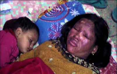 রংপুরে স্ত্রীকে অ্যাসিড নিক্ষেপ