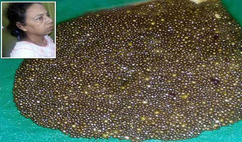 12,000 gallstones found inside woman’s stomach