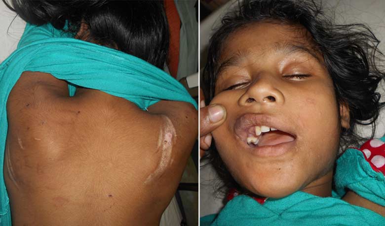 গরম খুন্তির ছ্যাঁকা, ফেলে দেওয়া হয়েছে দাঁত