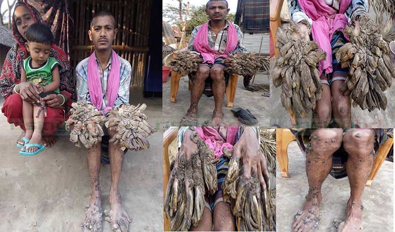 রাইজিংবিডির প্রতিবেদনে দেশবাসী জেনেছিল ট্রি ম্যানের কথা