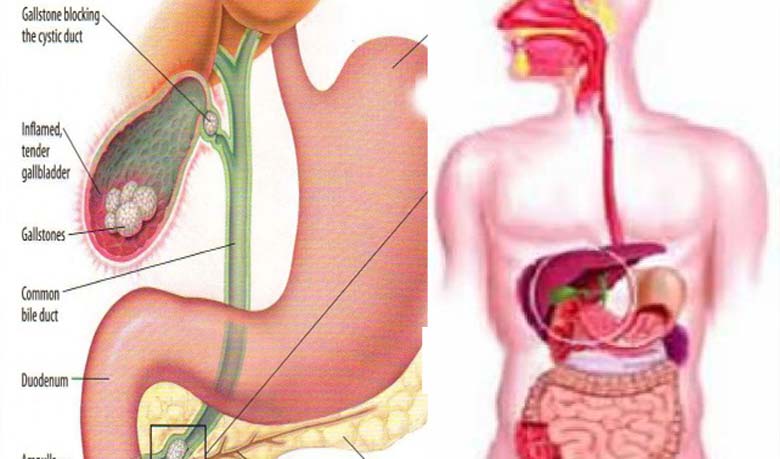 ল্যাপারোস্কোপিক পদ্ধতিতে পিত্তথলির পাথর অপারেশন নিয়ে বিভ্রান্তি