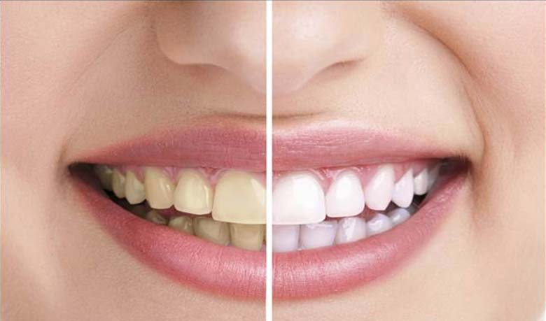 দাঁতের হলুদ দাগ দূর করার সহজ উপায়