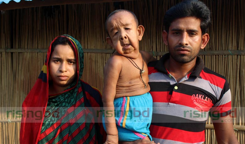 4-yr old Bangladesh boy suffers rare genetic disease