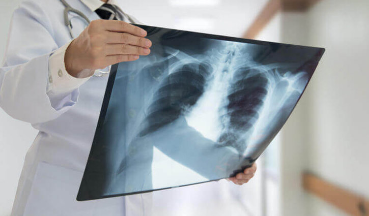 ফুসফুস ক্যানসার সম্পর্কে ১১ তথ্য