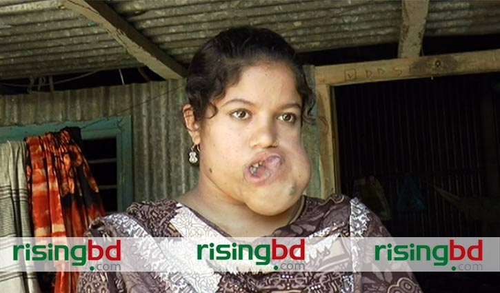 ভাসকুলার ম্যালফরমেশন রোগে আক্রান্ত তমা