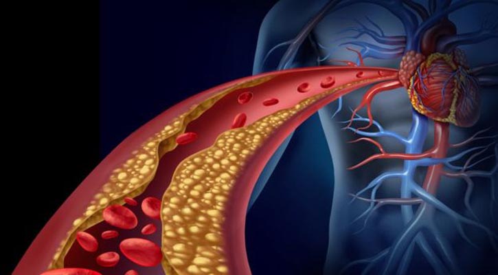 Cholesterol-lowering jab to help prevent heart disease
