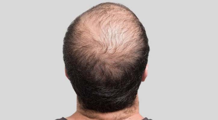Potential new cure found for baldness