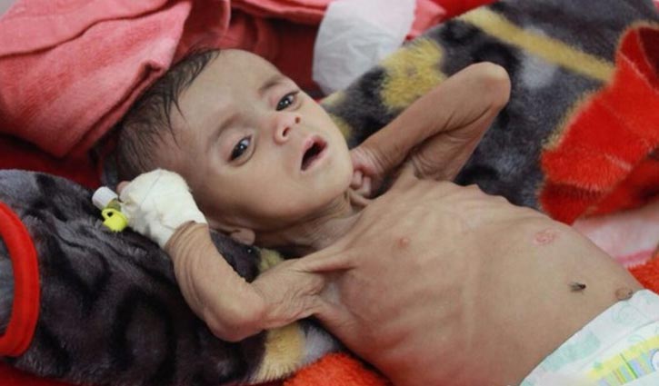 5.2 million children face famine in Yemen