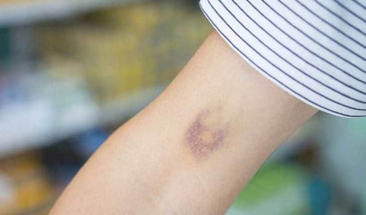 শরীরে কালশিটে দাগের যত অদ্ভুত কারণ