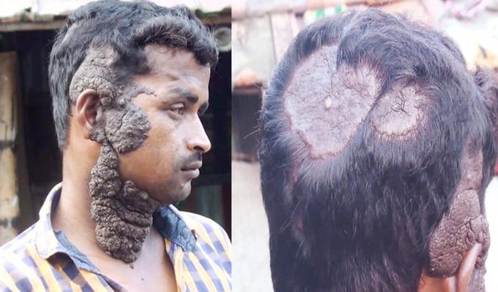দরিদ্র ভ্যান চালক পিন্টু বিরল রোগে আক্রান্ত দরিদ্র ভ্যান চালক পিন্টু বিরল রোগে আক্রান্ত