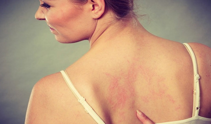 চিকিৎসক ছাড়াই একজিমা শনাক্ত করবেন যেভাবে