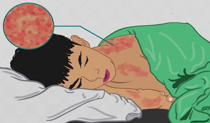 করোনা মহামারিতে এবার হামের প্রাদুর্ভাবের শঙ্কা