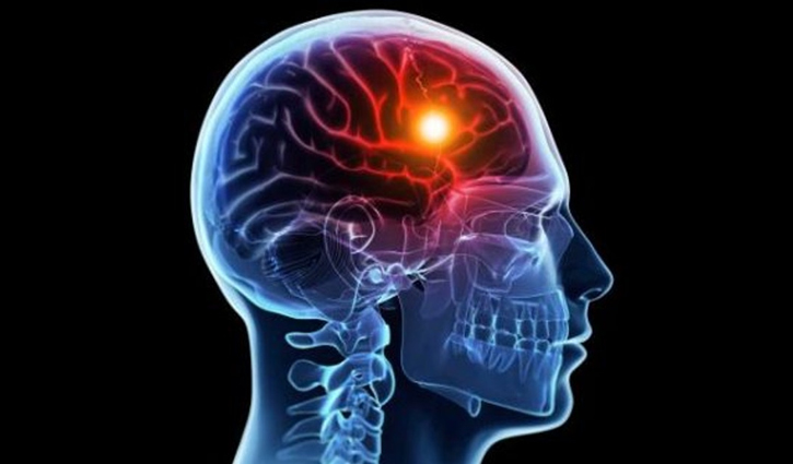 স্ট্রোকের ঝুঁকি কমাতে যা খাবেন