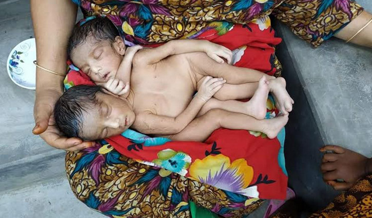 এক বুক নিয়ে দুই শিশুর জন্ম, আলাদা করা যাবে না এক বুক নিয়ে দুই শিশুর জন্ম, আলাদা করা যাবে না