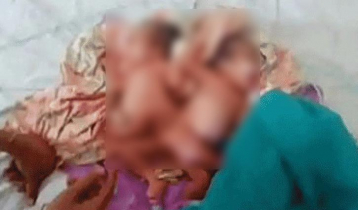 জোড়া লাগানো যমজ শিশুর জন্ম জোড়া লাগানো যমজ শিশুর জন্ম