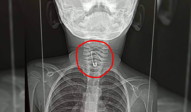 গলায় সেফটিপিন নিয়ে হাসপাতালে শিশু