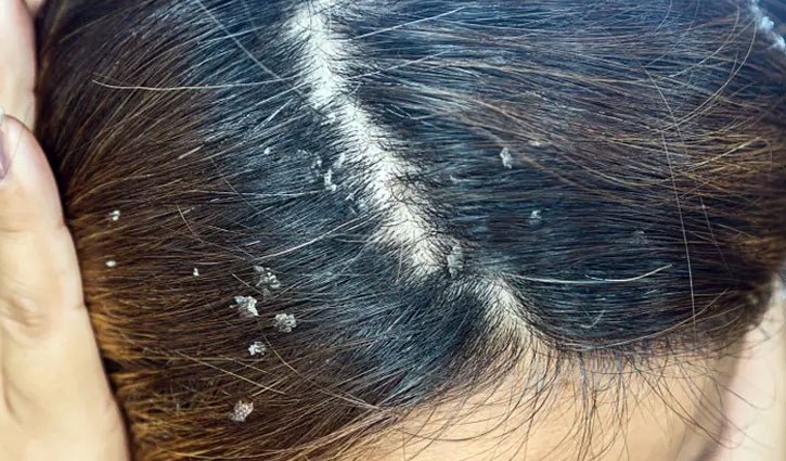 খুশকি থেকে মুক্তি পাওয়ার ৮ প্রাকৃতিক উপায়