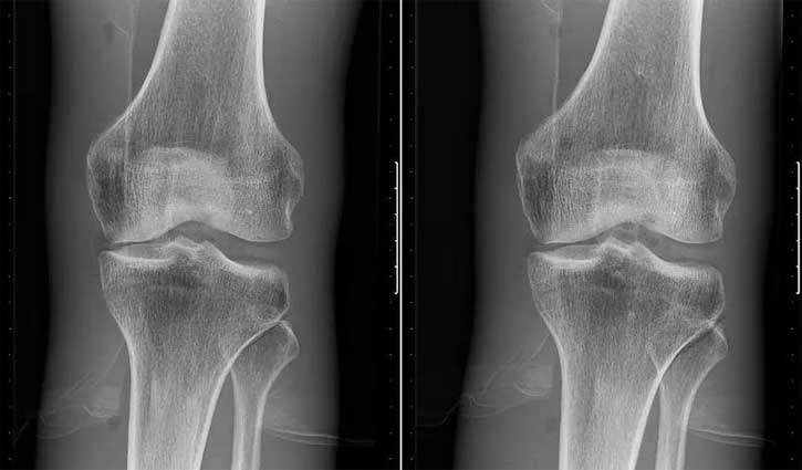 Common treatment for knee osteoarthritis `ineffective`: study