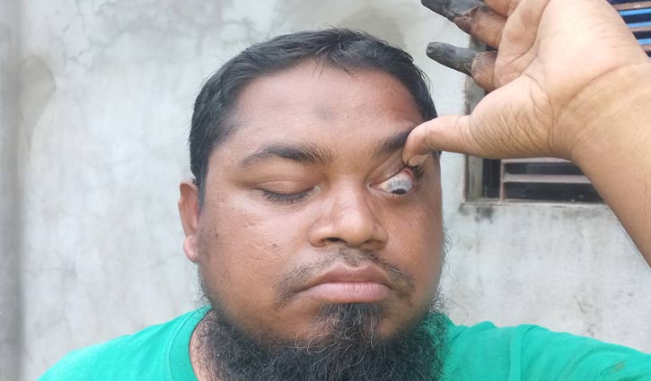 বিরল রোগ, বাংলাদেশে প্রথম শনাক্ত নূরুল আমীন বিরল রোগ, বাংলাদেশে প্রথম শনাক্ত নূরুল আমীন