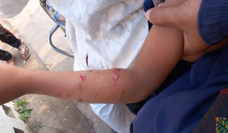15 children among 21 suffer injuries as dog bites them
