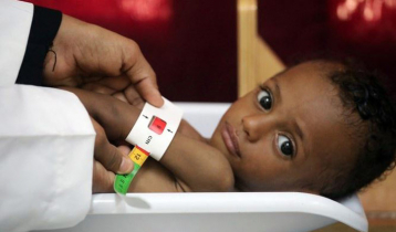 Millions of children face risk of malnutrition in Yemen