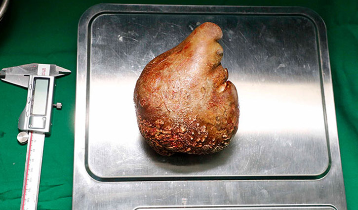 বিশ্বের বৃহত্তম কিডনি পাথর অপসারণ