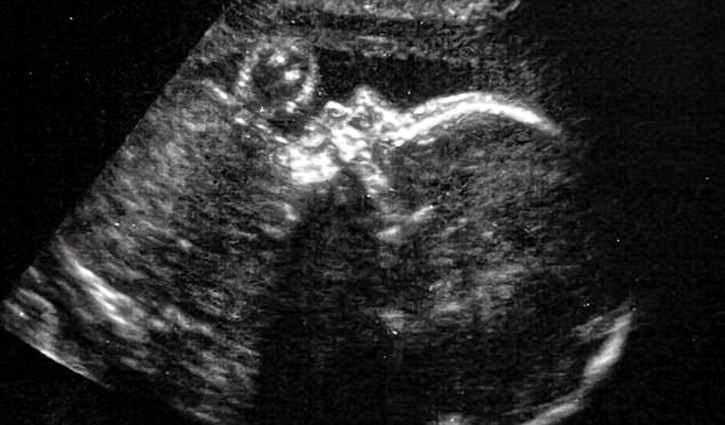 Doctors perform brain surgery of unborn baby in womb