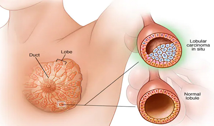 স্তন ক্যান্সারে বছরে মারা যাচ্ছেন ৮ হাজার নারী