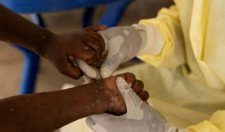 First case of more dangerous mpox found outside Africa