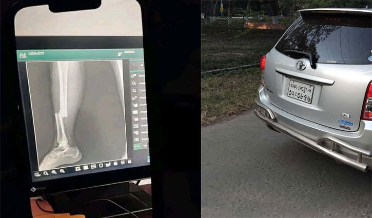 শিক্ষকের গাড়ির ধাক্কায় পা ভাঙল রাবি শিক্ষার্থীর