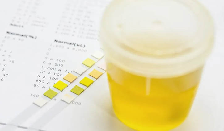 প্রস্রাবের সঙ্গে ফেনা বের হওয়া মানেই কি কিডনী রোগ?