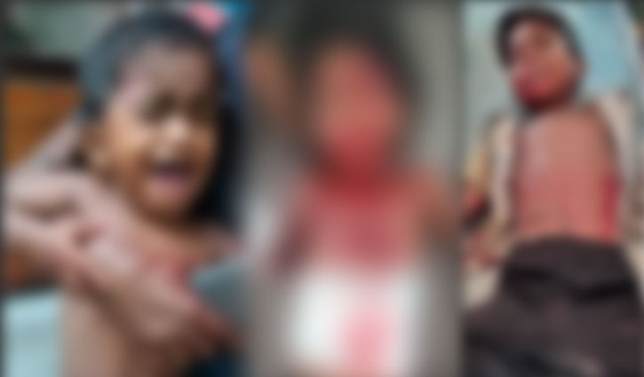 Three children hurt in cocktail explosion in Jashore Three children hurt in cocktail explosion in Jashore