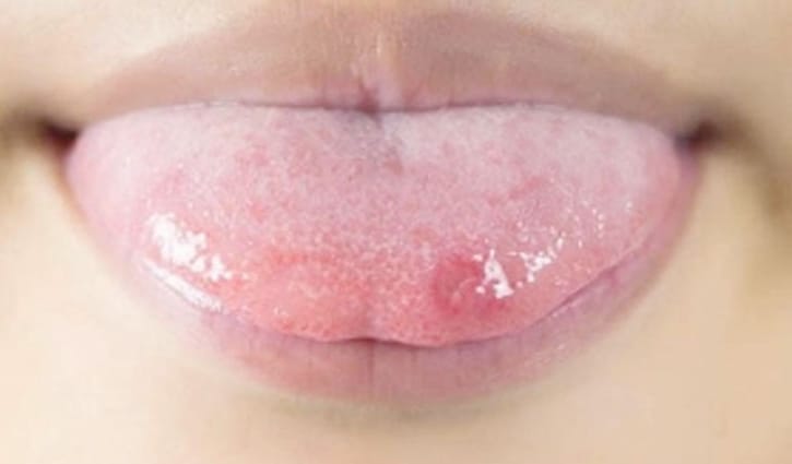 জিহ্বায় ঘা হলে করণীয়