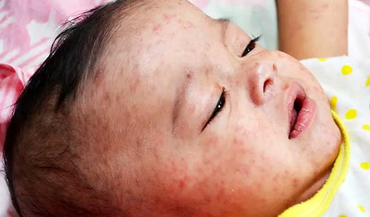 কুষ্টিয়ায় হামের উপসর্গে হাসপাতালে ভর্তি ২৮