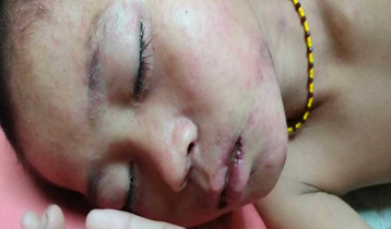দুর্গম পাহাড়ে হামের সংক্রমণ, ১৯ শিশু হাসপাতালে ভর্তি 