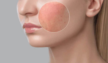 শীতেও ত্বকে ট্যান! কীভাবে  দূর করবেন জেনে নিন