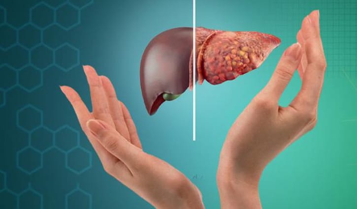 ওবেসিটি থেকে ফ্যাটি লিভার: নীরব বিপদের লক্ষণ চিনুন