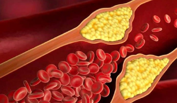 রক্তে খারাপ কোলেস্টেরল বেড়ে গেলে করণীয়